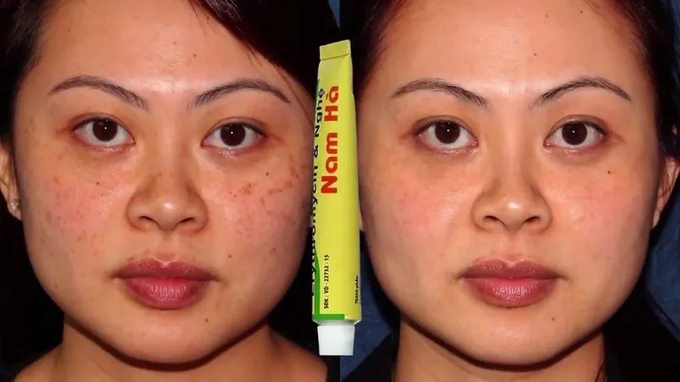 Kem nghệ Nam Hà với kháng sinh