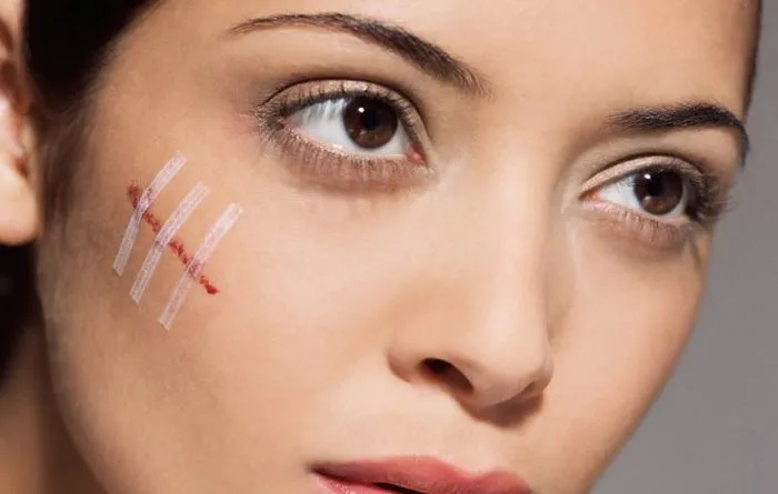 [Giải Đáp] Bị sẹo nên kiêng ăn gì để tránh Sẹo Lồi?