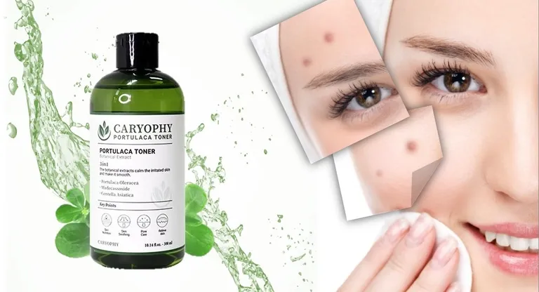 Nước hoa hồng trị mụn Caryophy Portulaca Toner