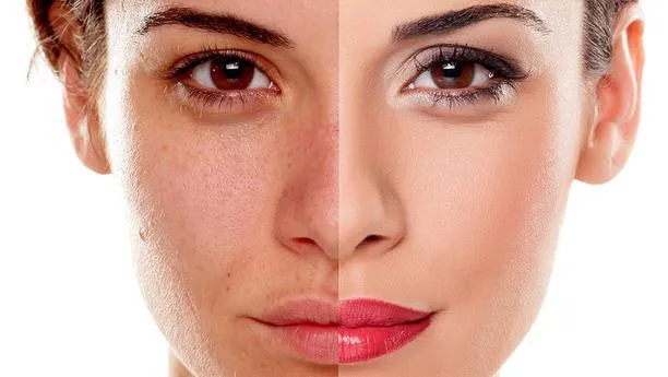 Review top 10 kem trị nám tàn nhang hiệu quả được tin dùng nhất